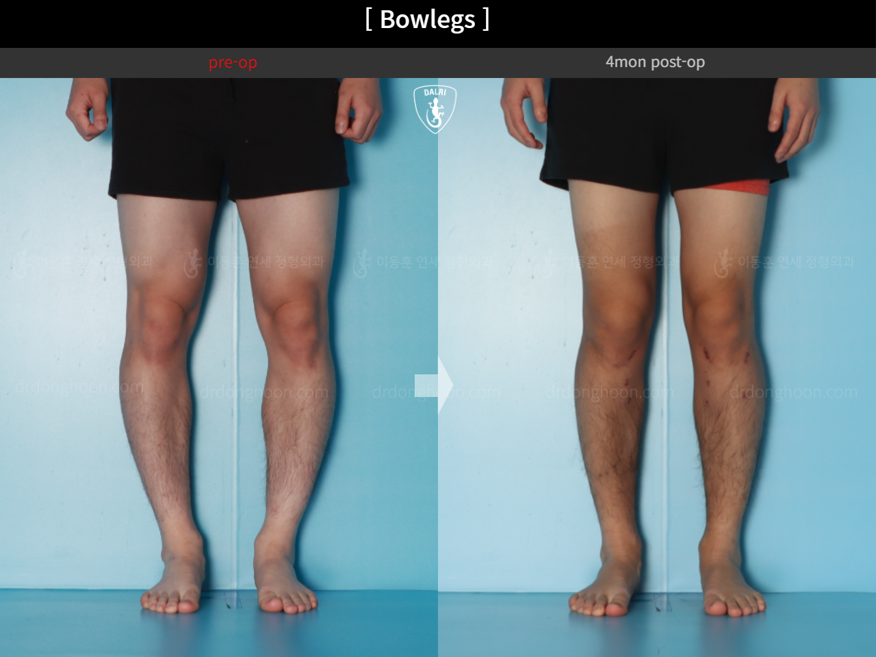 Before and after adult bowlegs, case 18479637, image 8, Dr. Donghoon institute (DALRI)