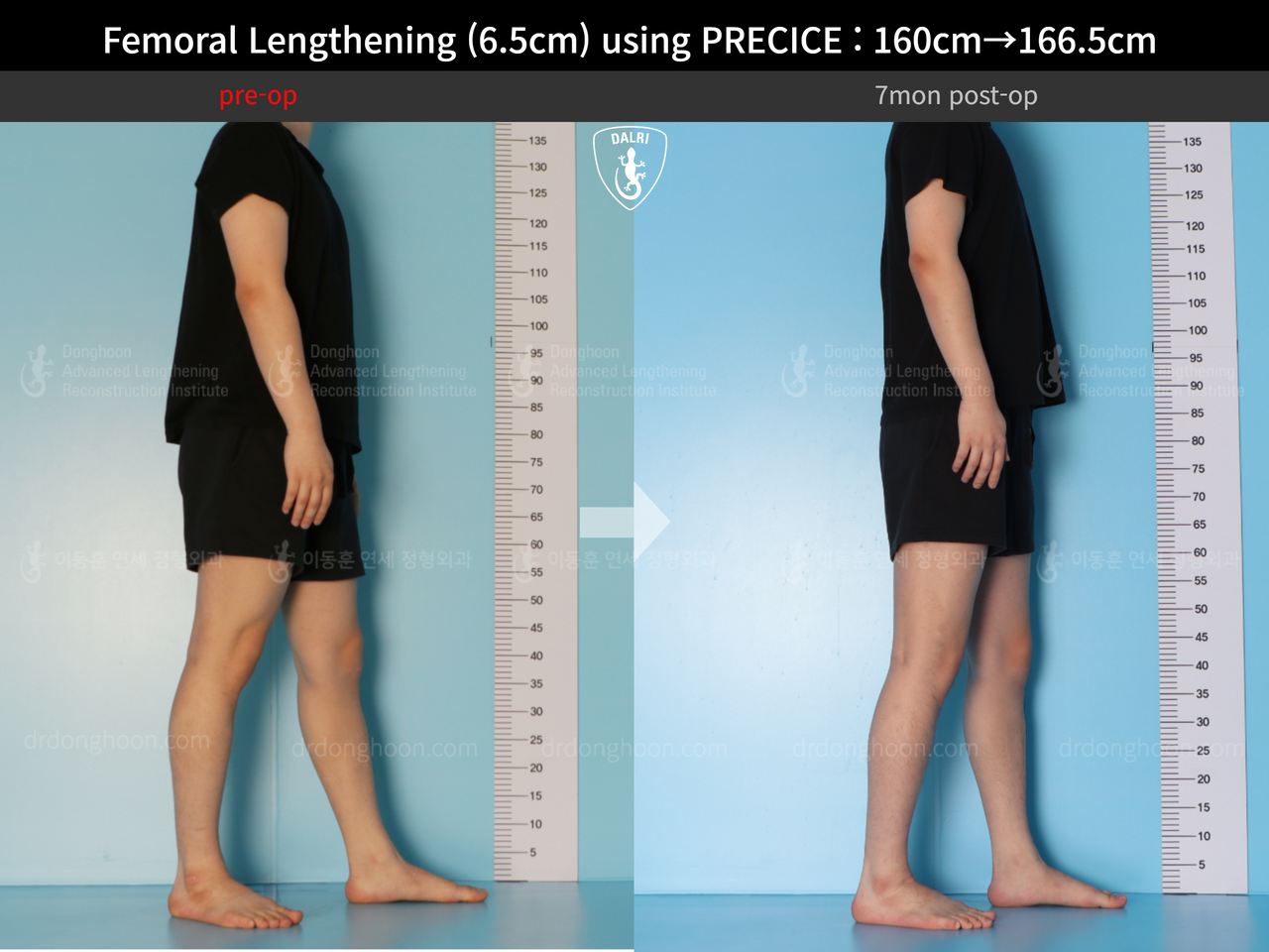Before and after cll precice, case 13413485, image 6, Dr. Donghoon institute (DALRI)