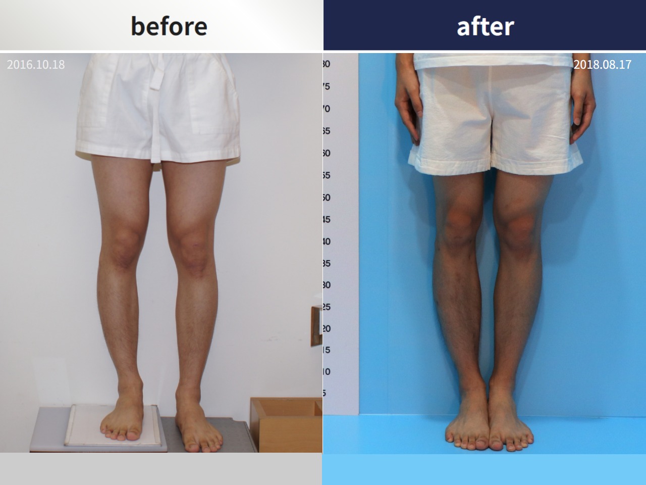 Before and after adult lld, case 4320291, image 3, Dr. Donghoon institute (DALRI)