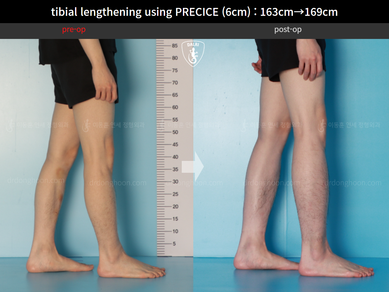 Before and after cll precice, case 16061529, image 9, Dr. Donghoon institute (DALRI)