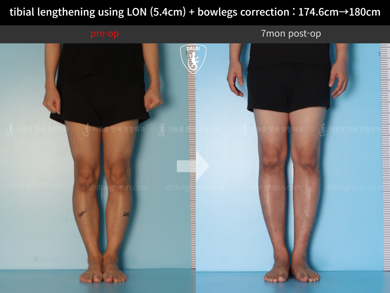 Before and after cll + deformity correction, case 12718558, image 7, Dr. Donghoon institute (DALRI)