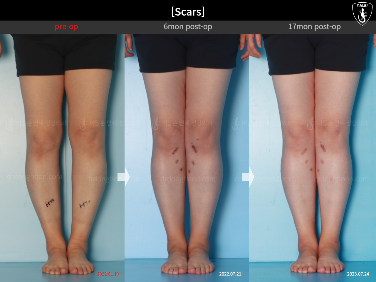 Before and after osteotomy for knee osteoarthritis, case 15944917, image 7, Dr. Donghoon institute (DALRI)