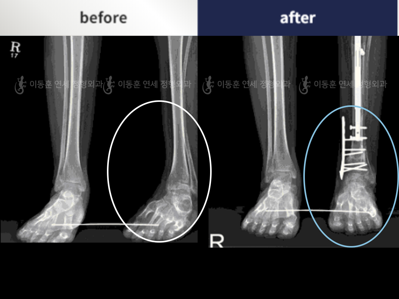 Before and after congenital condition, case 4795353, image 5, Dr. Donghoon institute (DALRI)