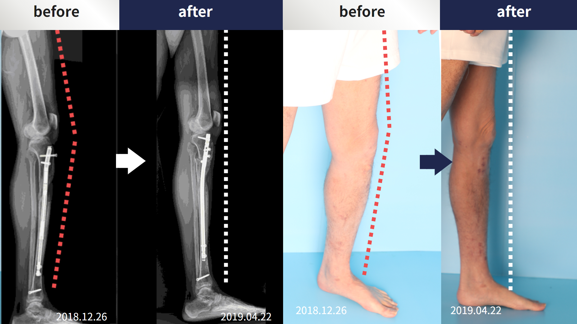 Before and after re-operation for cll, case 4465600, image 3, Dr. Donghoon institute (DALRI)