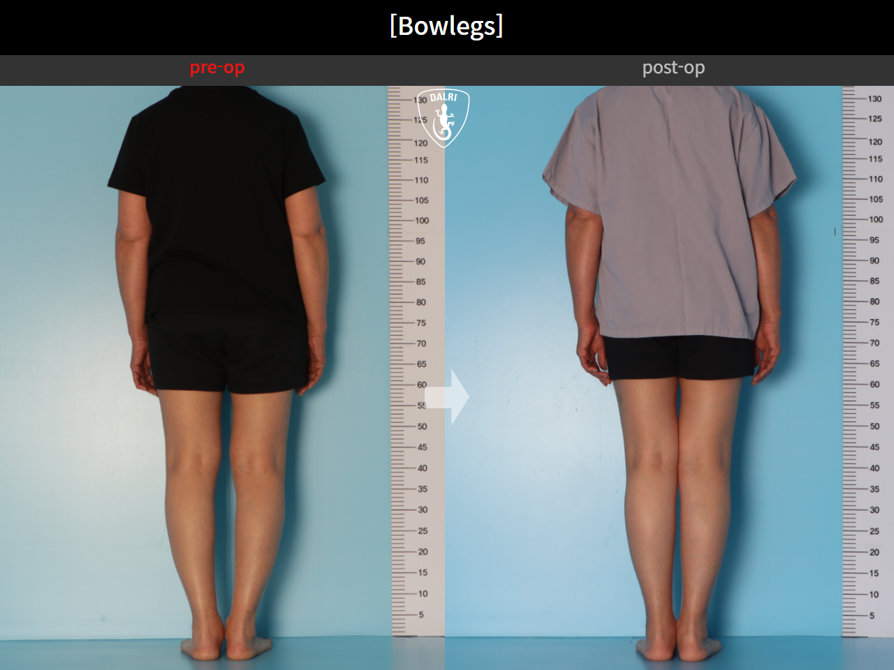 Before and after adult bowlegs, case 30770070, image 4, Dr. Donghoon institute (DALRI)
