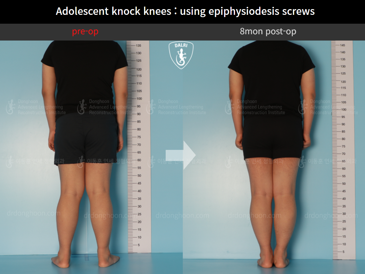 Before and after paediatric & adolescent knock knees, case 9743785, image 2, Dr. Donghoon institute (DALRI)