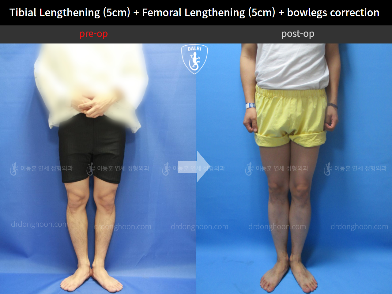 Before and after cll + deformity correction, case 4323174, image 2, Dr. Donghoon institute (DALRI)