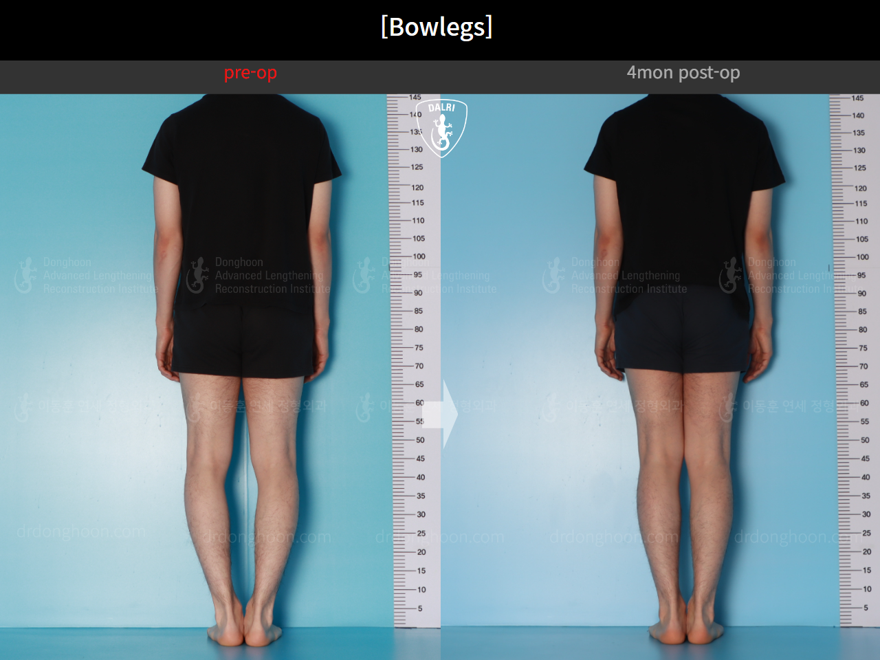 Before and after adult bowlegs, case 21098909, image 4, Dr. Donghoon institute (DALRI)