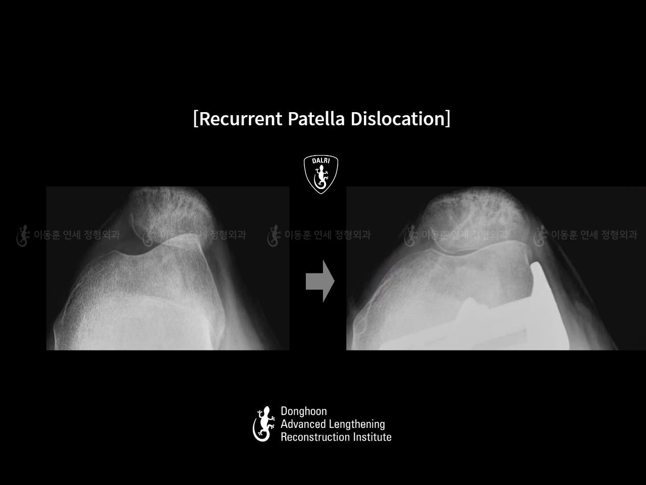 Before and after adult bowlegs, case 18088212, image 11, Dr. Donghoon institute (DALRI)