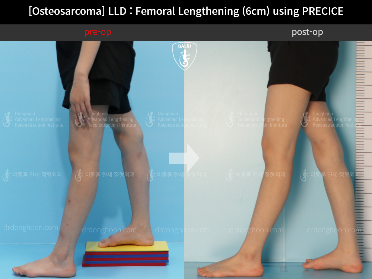 Before and after post-trauma deformity, case 11378057, image 4, Dr. Donghoon institute (DALRI)