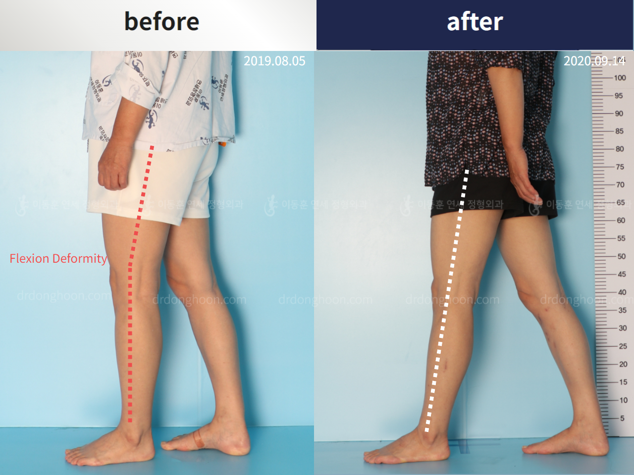 Before and after flexion deformity, case 4885851, image 1, Dr. Donghoon institute (DALRI)