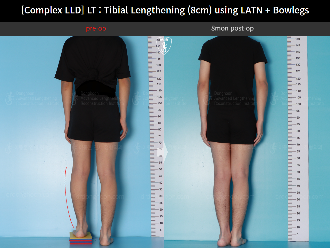 Before and after adult lld, case 16724300, image 2, Dr. Donghoon institute (DALRI)