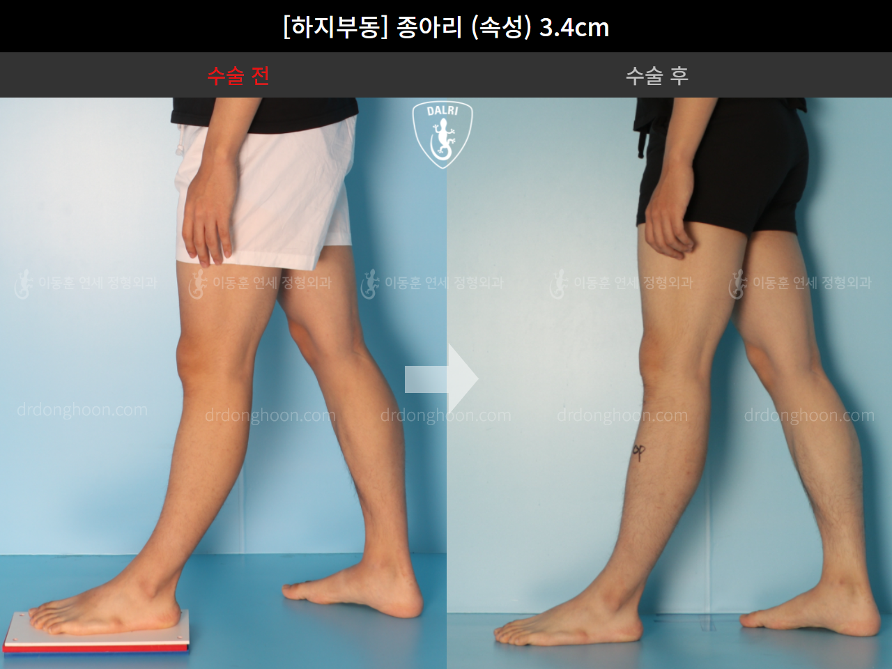 Before and after adult lld, case 4585742, image 6, Dr. Donghoon institute (DALRI)