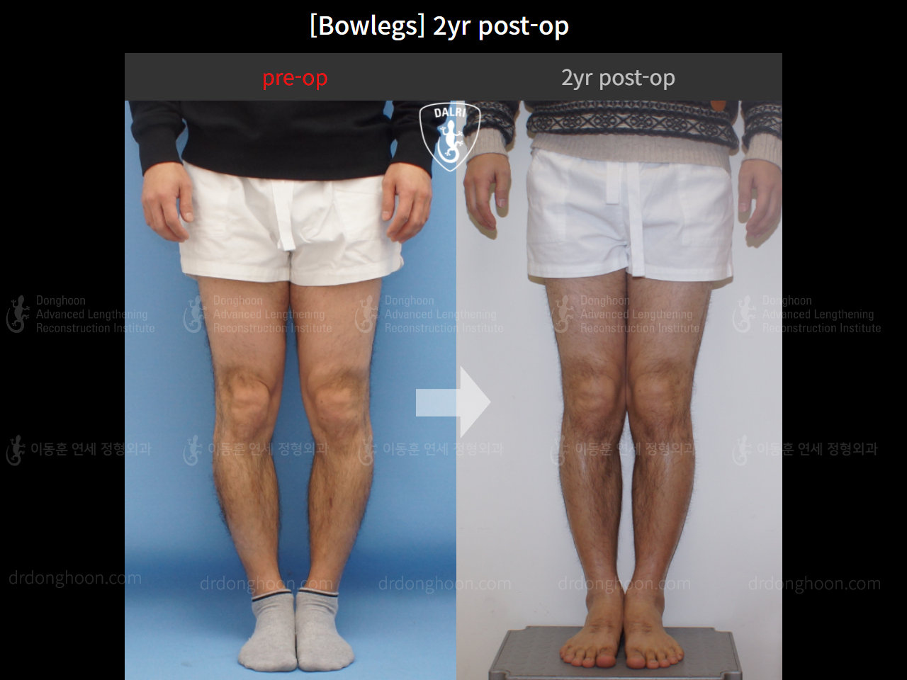 Before and after adult bowlegs, case 4311027, image 3, Dr. Donghoon institute (DALRI)