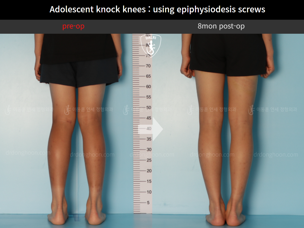 Before and after paediatric & adolescent knock knees, case 10171145, image 4, Dr. Donghoon institute (DALRI)