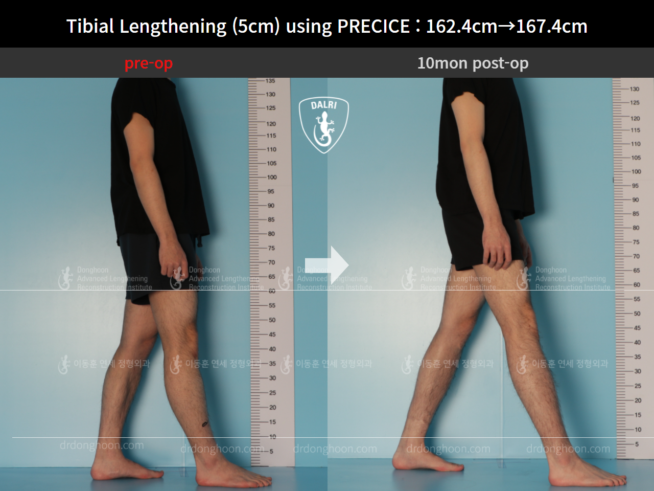 Before and after cll precice, case 9101885, image 4, Dr. Donghoon institute (DALRI)