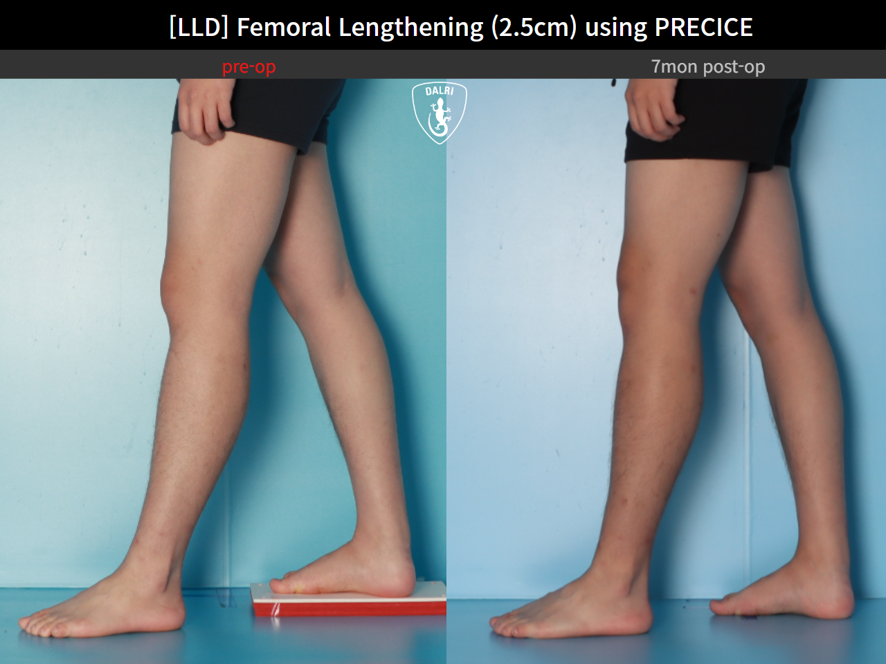 Before and after adult lld, case 127180202, image 8, Dr. Donghoon institute (DALRI)