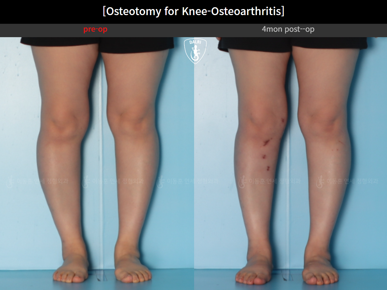 Before and after osteotomy for knee osteoarthritis, case 39778471, image 10, Dr. Donghoon institute (DALRI)