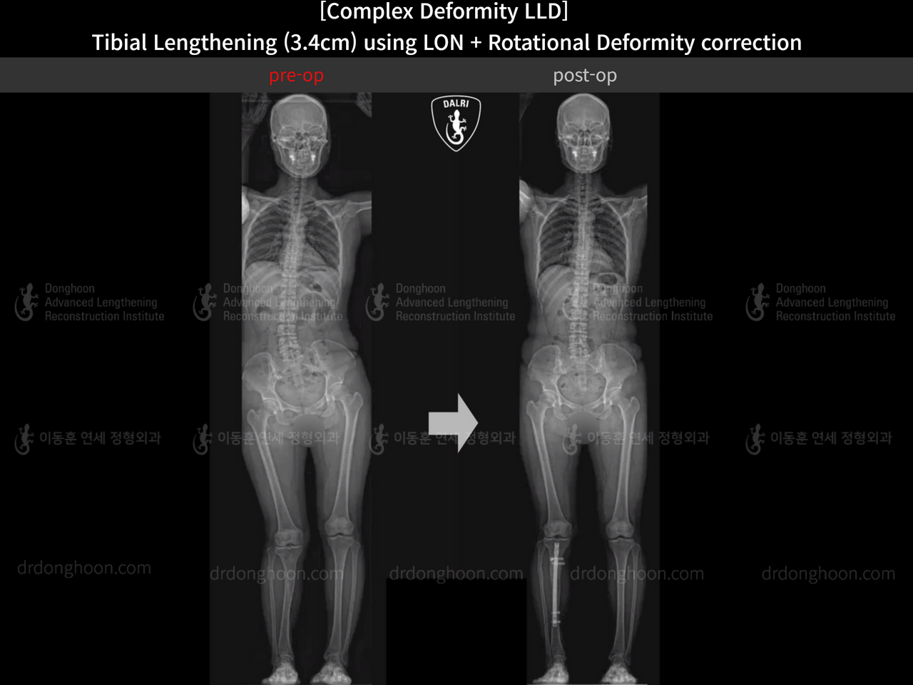 Before and after adult lld, case 14350311, image 7, Dr. Donghoon institute (DALRI)