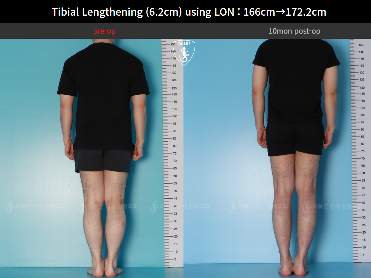 Before and after cll lon, case 128591201, image 3, Dr. Donghoon institute (DALRI)