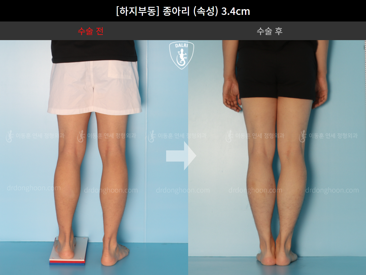 Before and after adult lld, case 4585742, image 5, Dr. Donghoon institute (DALRI)