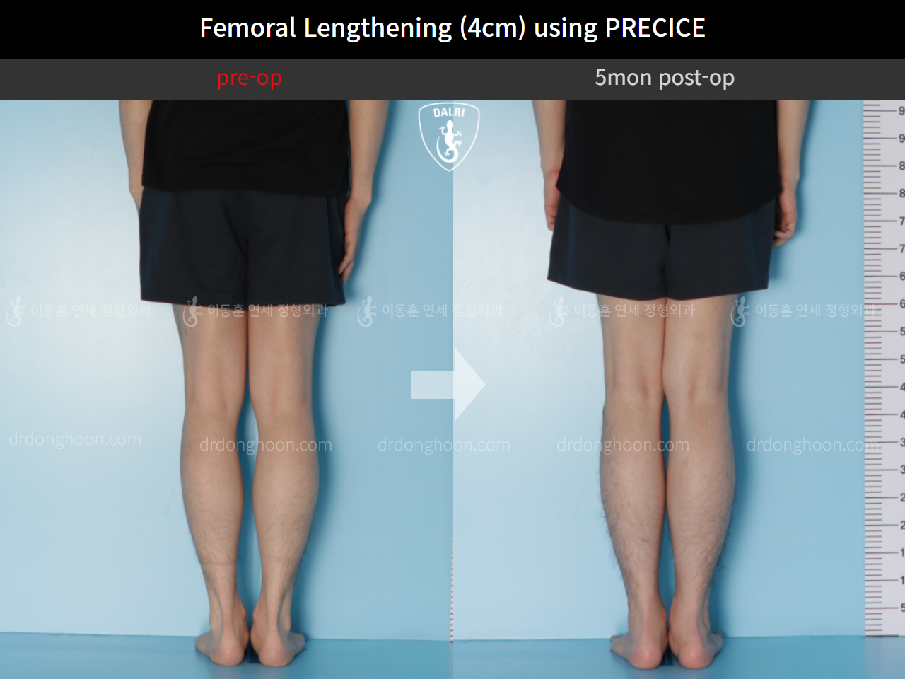 Before and after cll lon, case 5315963, image 4, Dr. Donghoon institute (DALRI)
