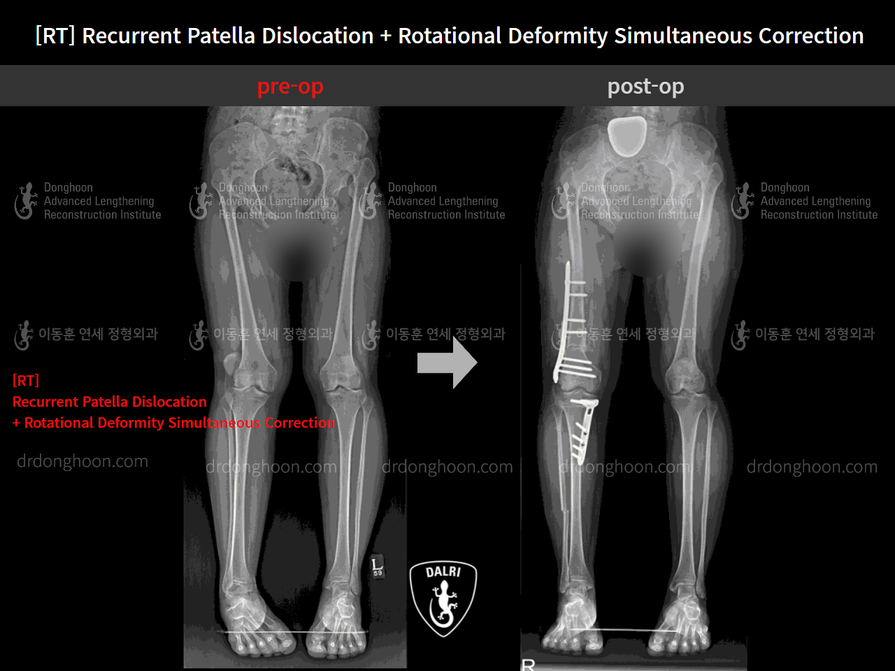 Before and after recurrent patella dislocation, case 9159612, image 3, Dr. Donghoon institute (DALRI)