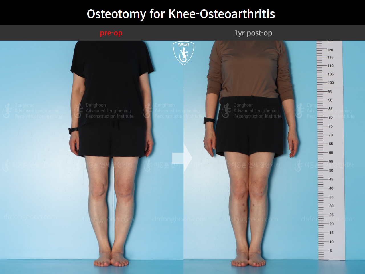 Before and after osteotomy for knee osteoarthritis, case 16893966, image 1, Dr. Donghoon institute (DALRI)