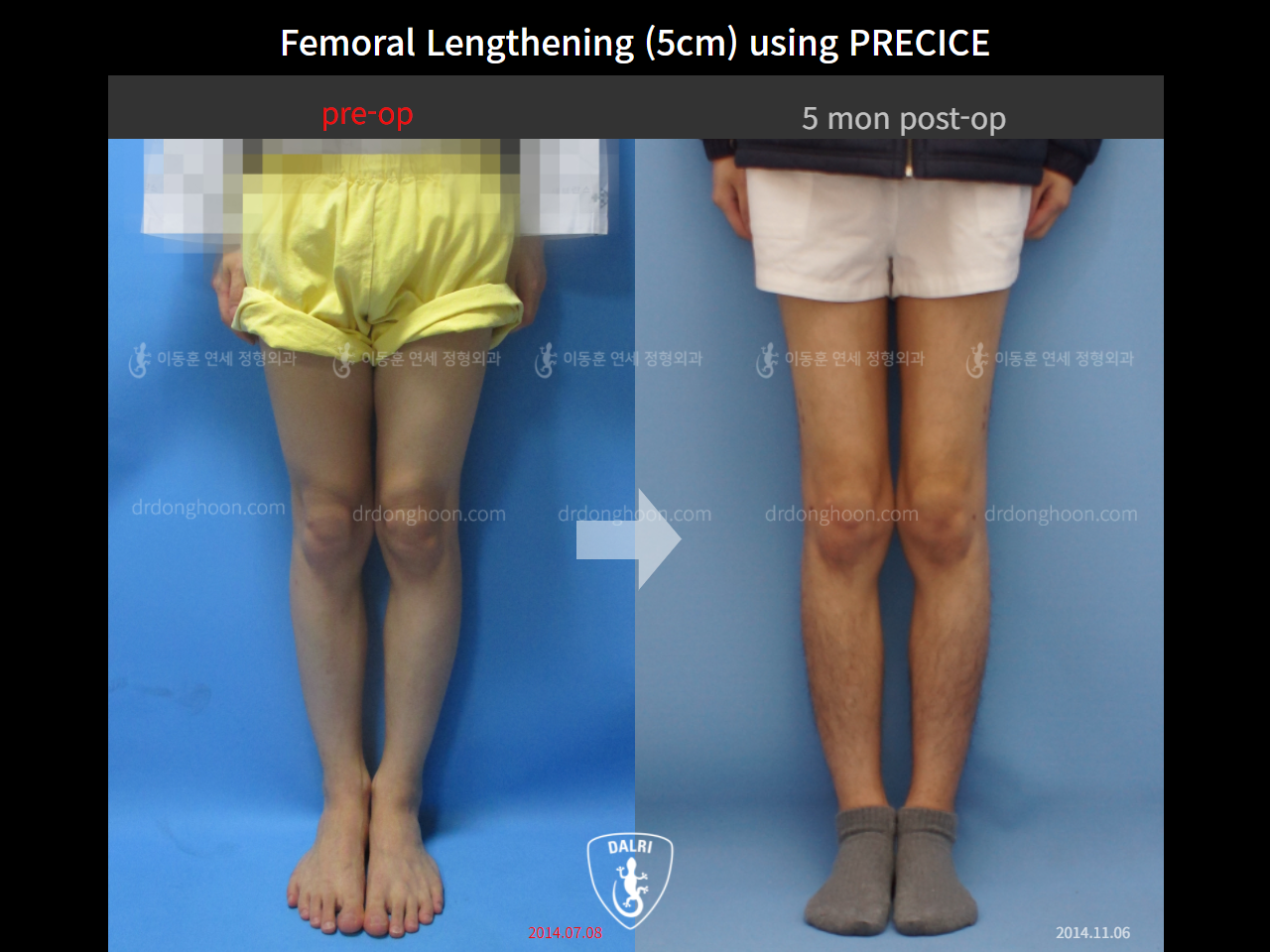Before and after cll precice, case 9231745, image 4, Dr. Donghoon institute (DALRI)