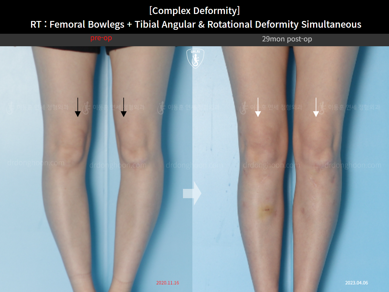 Before and after adult bowlegs, case 14771490, image 11, Dr. Donghoon institute (DALRI)