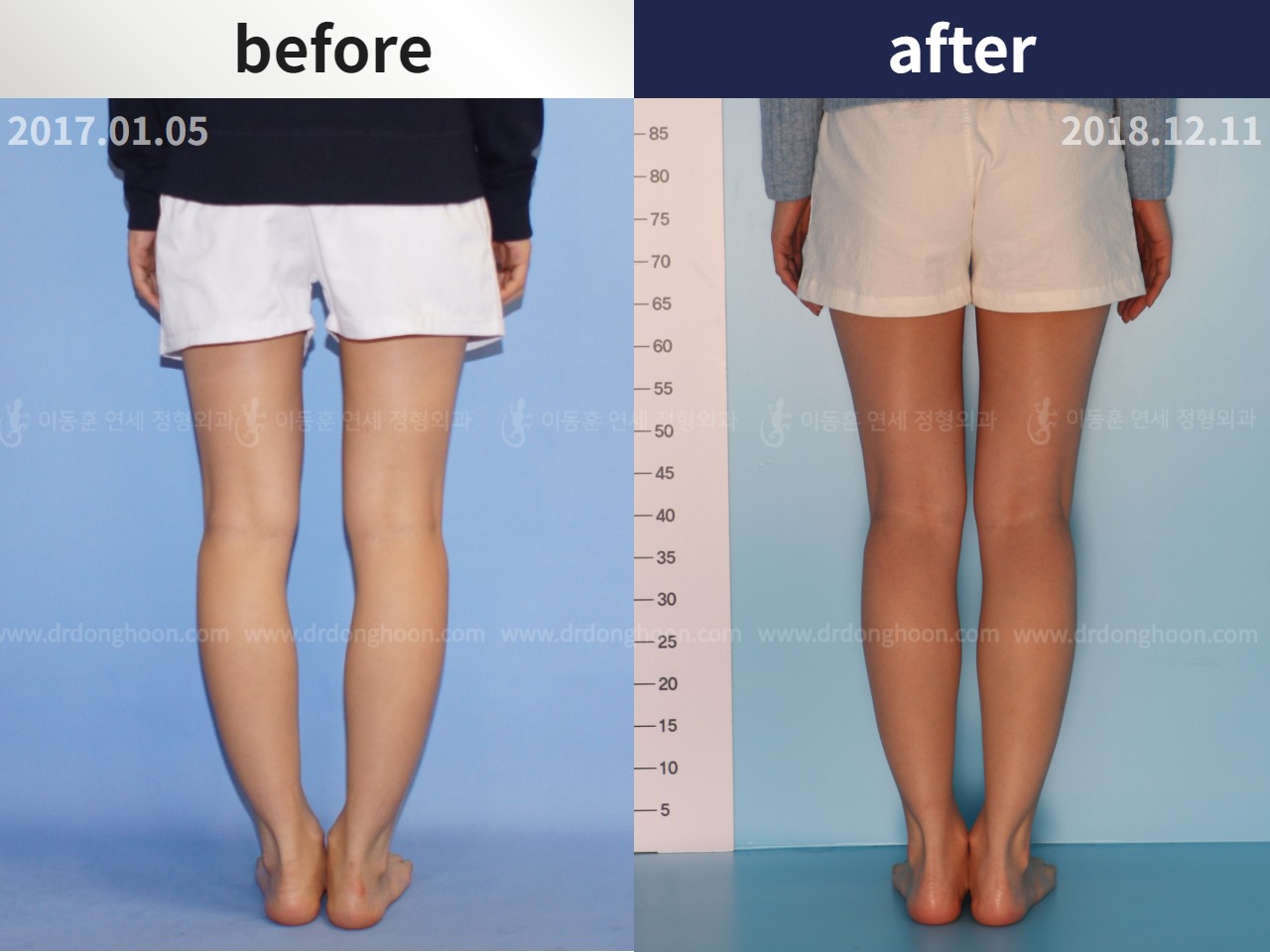 Before and after adult bowlegs, case 4311000, image 2, Dr. Donghoon institute (DALRI)