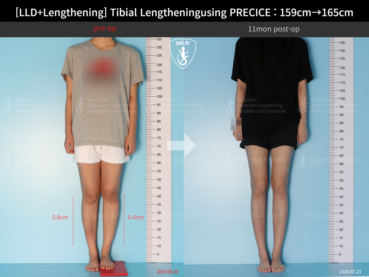 Before and after cll precice, case 13252418, image 1, Dr. Donghoon institute (DALRI)