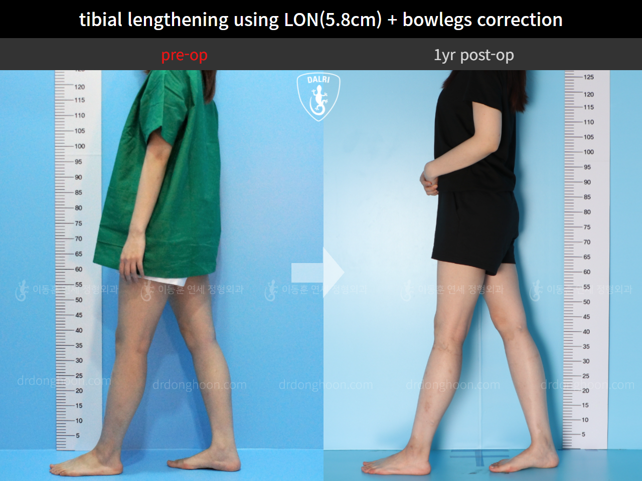 Before and after cll lon, case 4577846, image 4, Dr. Donghoon institute (DALRI)