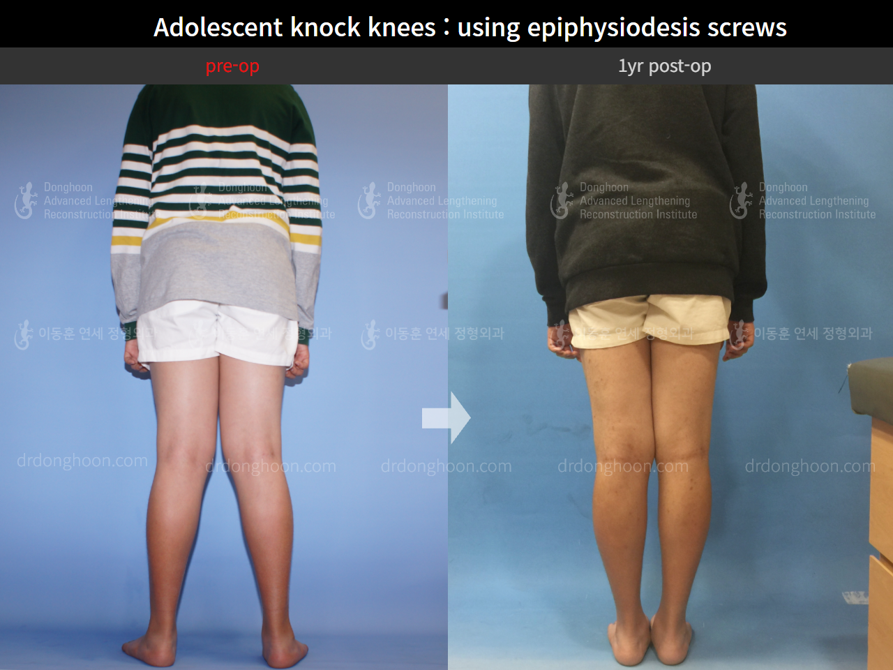 Before and after paediatric & adolescent knock knees, case 4310939, image 2, Dr. Donghoon institute (DALRI)
