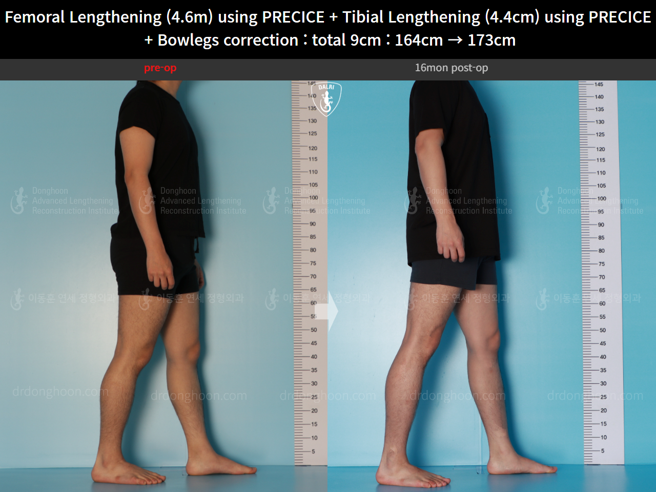 Before and after cll + deformity correction, case 16697522, image 6, Dr. Donghoon institute (DALRI)
