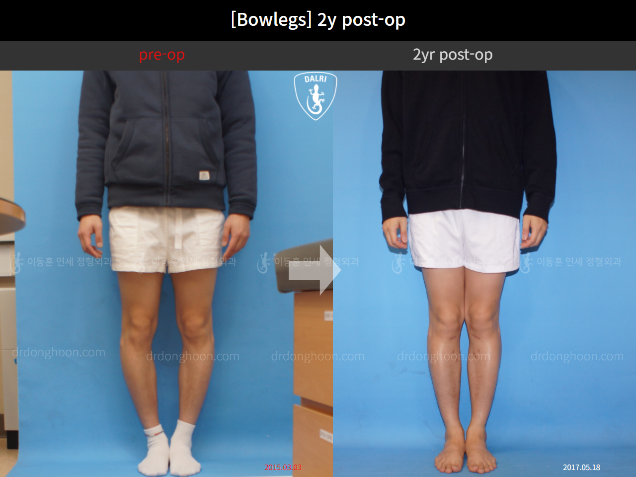 Before and after adult bowlegs, case 4311131, image 1, Dr. Donghoon institute (DALRI)