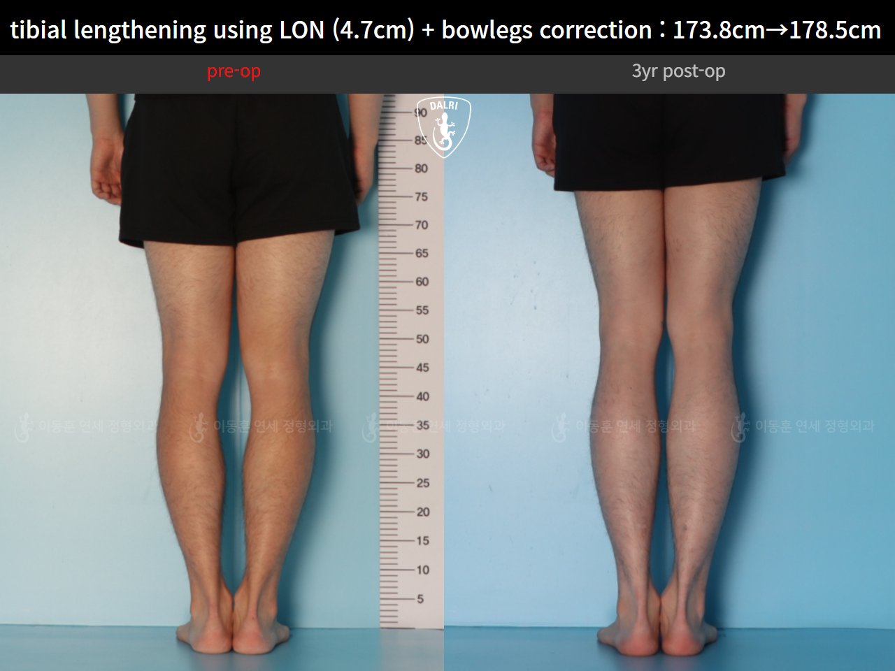 Before and after cll lon, case 128583026, image 8, Dr. Donghoon institute (DALRI)