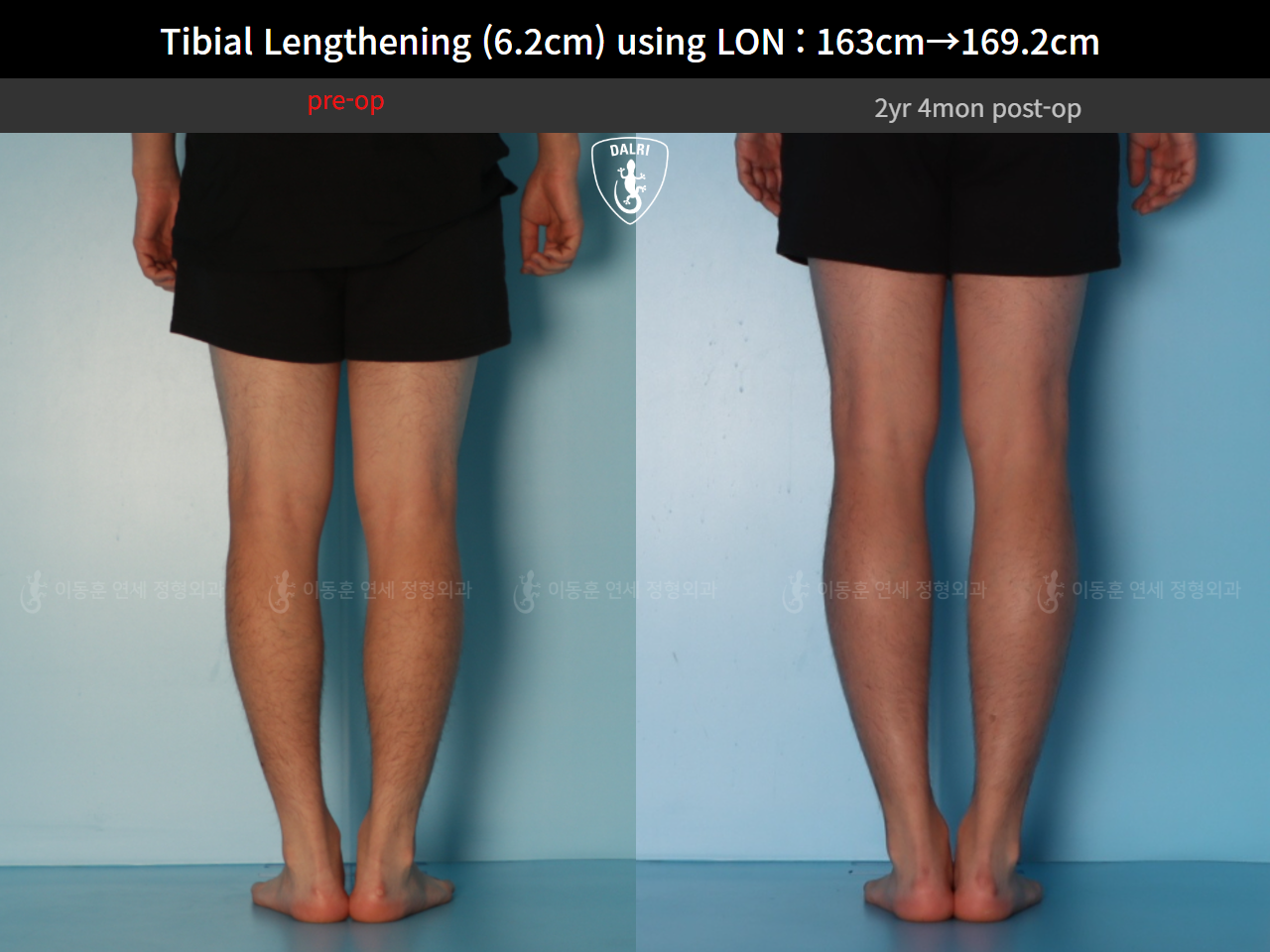Before and after cll lon, case 128449546, image 8, Dr. Donghoon institute (DALRI)