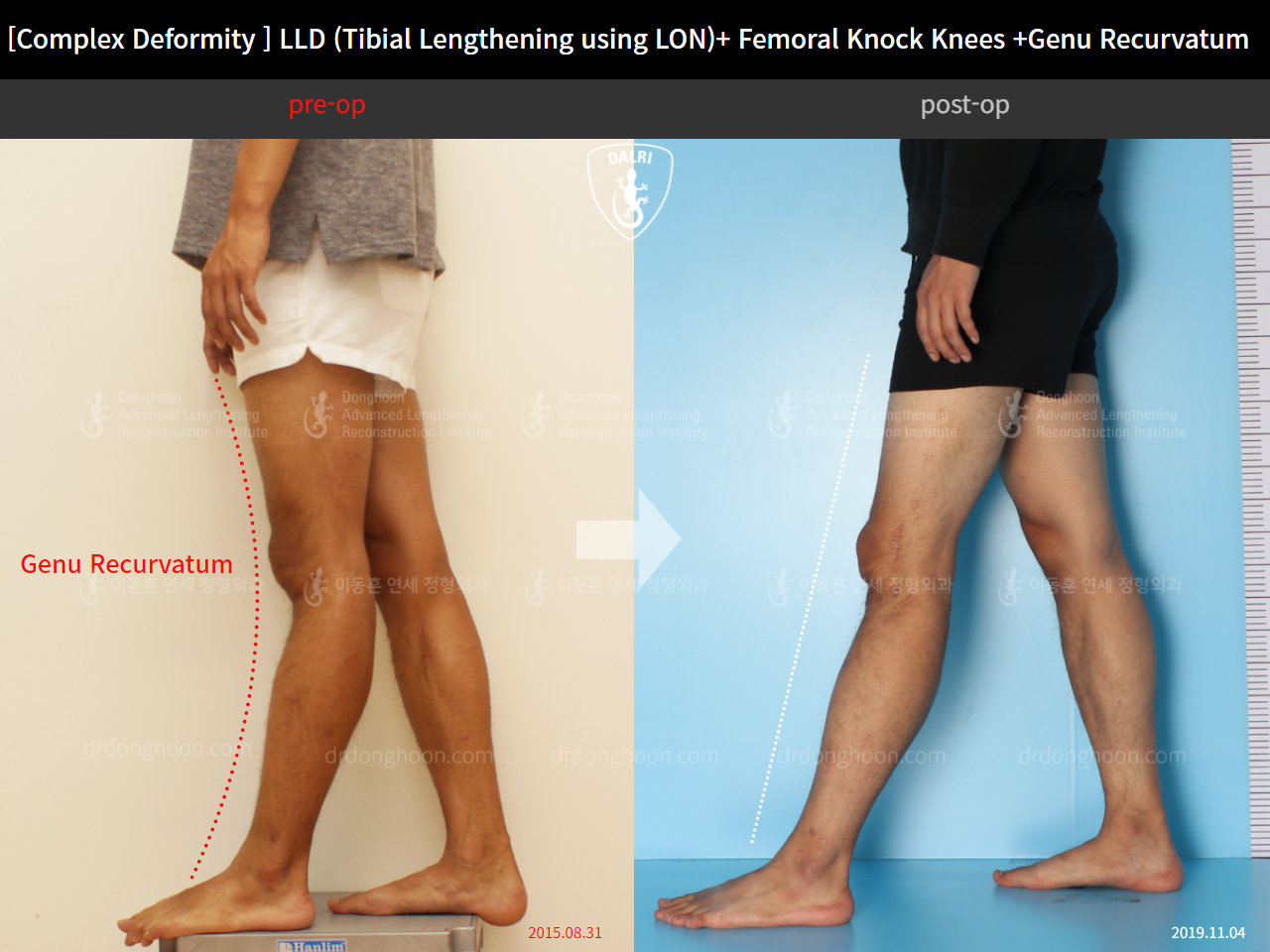 Before and after adult lld, case 4320339, image 6, Dr. Donghoon institute (DALRI)