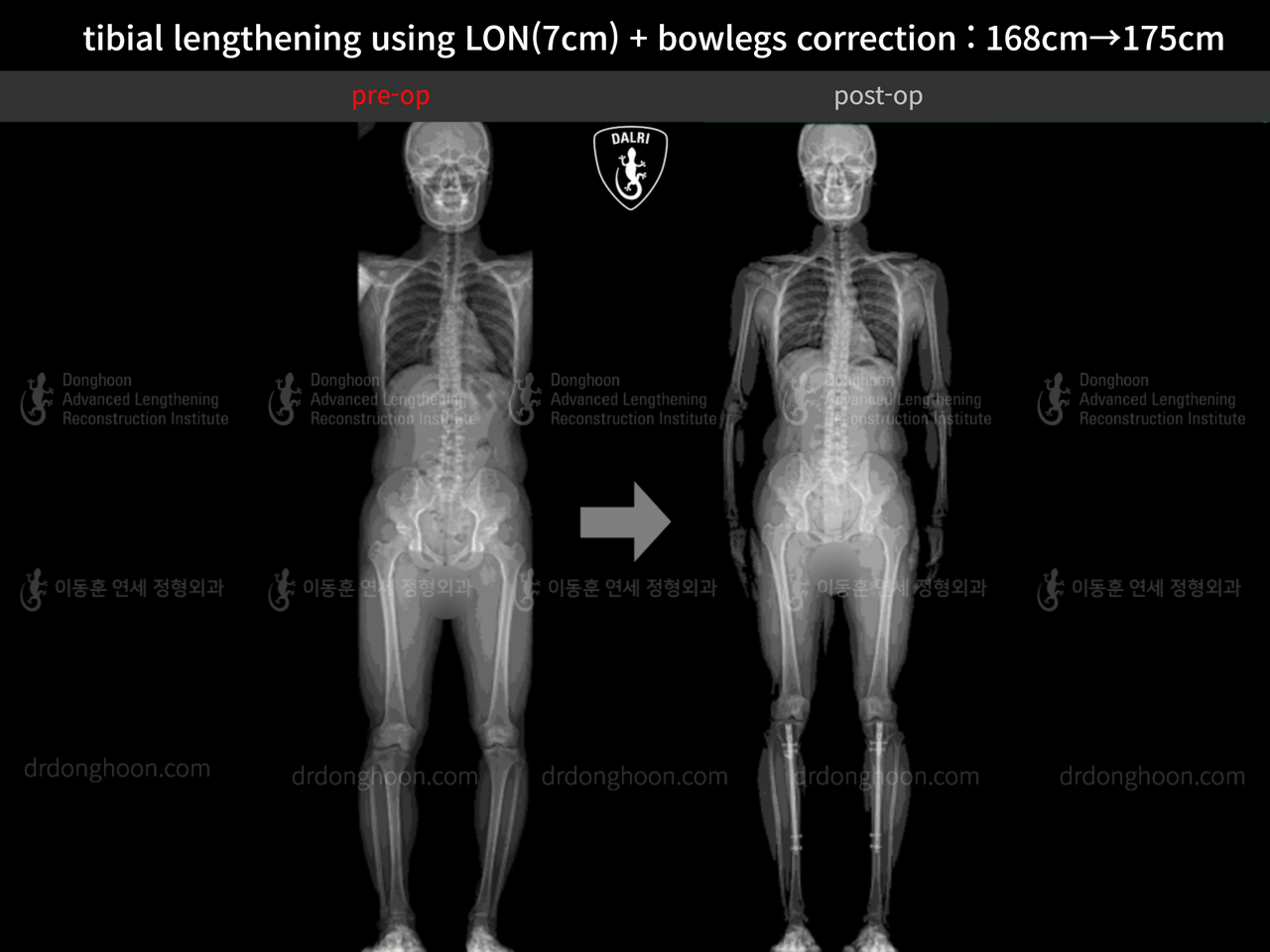 Before and after cll + deformity correction, case 13418393, image 1, Dr. Donghoon institute (DALRI)