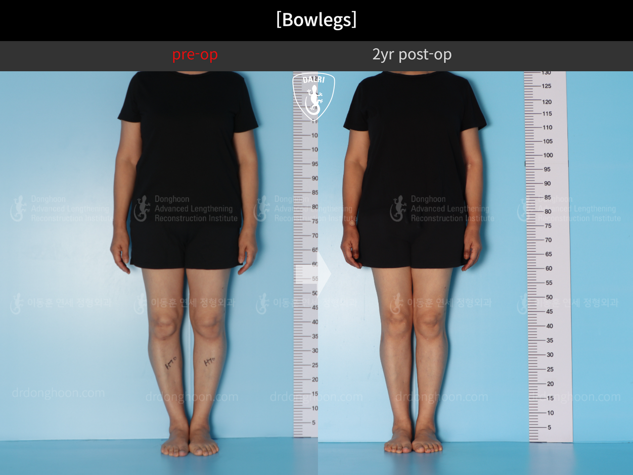Before and after adult bowlegs, case 13250883, image 3, Dr. Donghoon institute (DALRI)