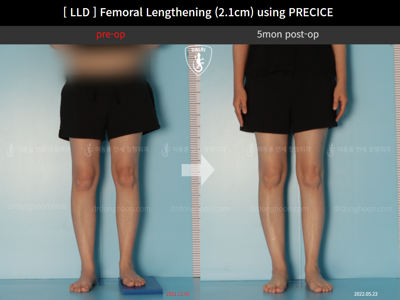 Before and after adult lld, case 11784618, image 4, Dr. Donghoon institute (DALRI)