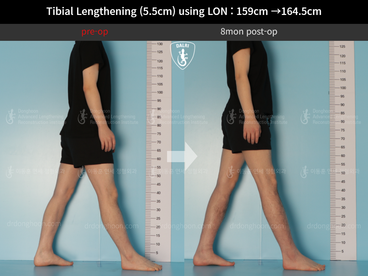 Before and after cll lon, case 10444923, image 4, Dr. Donghoon institute (DALRI)