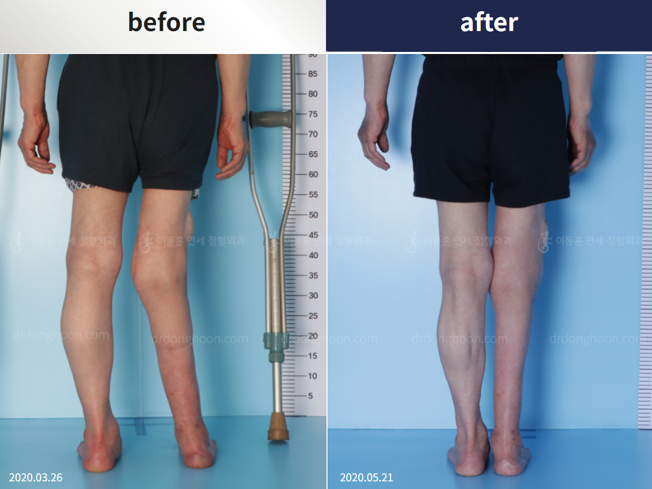 Before and after congenital condition, case 4304680, image 3, Dr. Donghoon institute (DALRI)