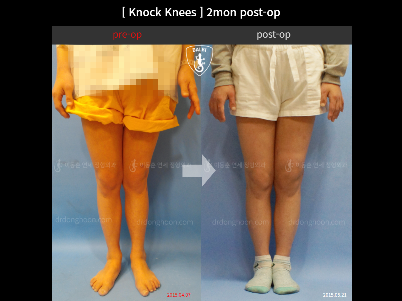 Before and after adult knock knees, case 4640593, image 1, Dr. Donghoon institute (DALRI)