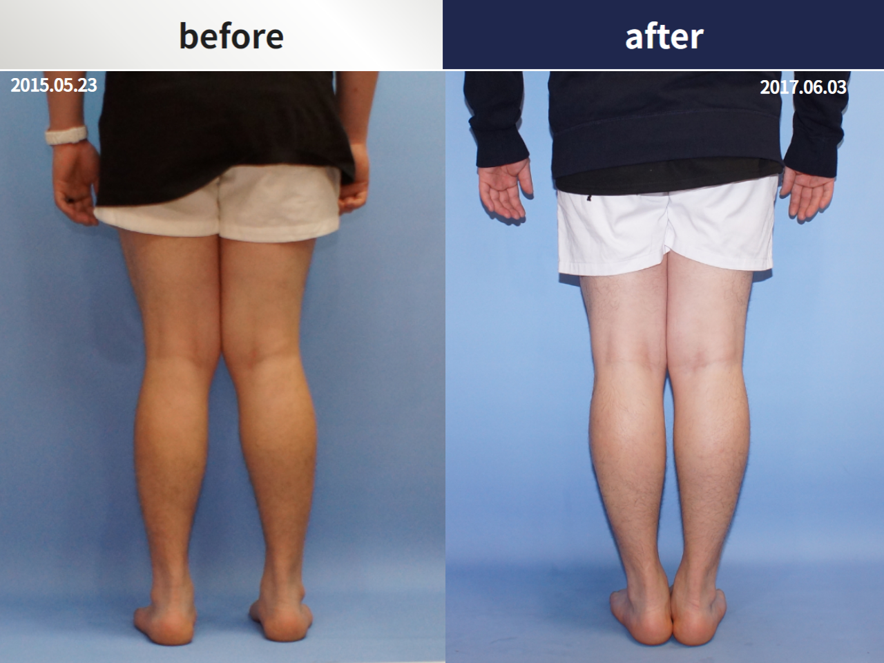 Before and after reoperation after deformity correction, case 4306345, image 2, Dr. Donghoon institute (DALRI)