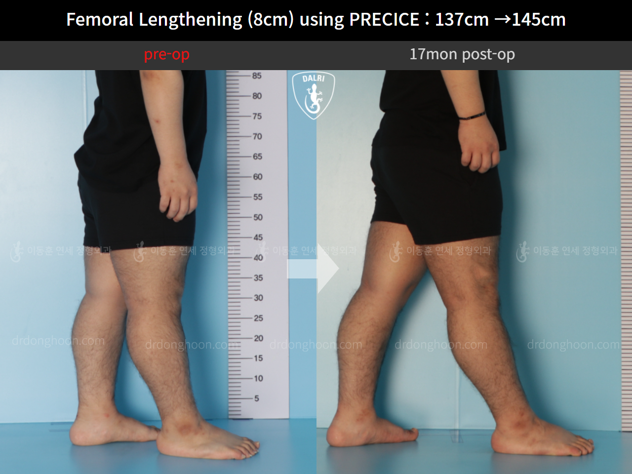 Before and after cll precice, case 9658893, image 7, Dr. Donghoon institute (DALRI)