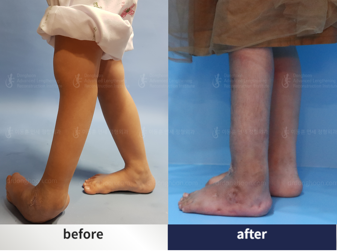 Before and after congenital clubfoot, case 4233838, image 1, Dr. Donghoon institute (DALRI)