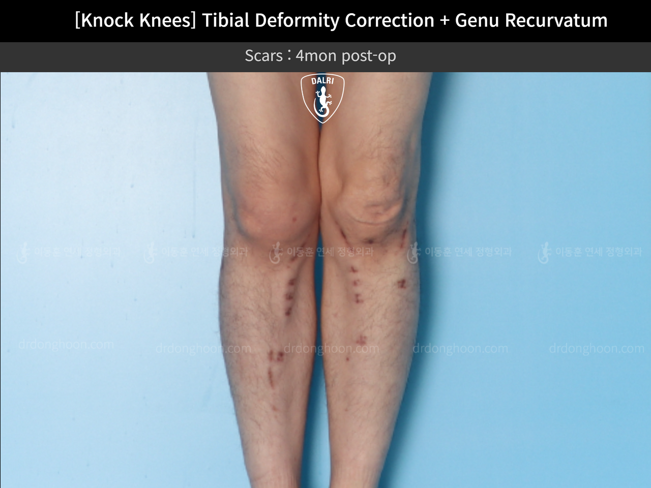 Before and after adult knock knees, case 12846255, image 7, Dr. Donghoon institute (DALRI)