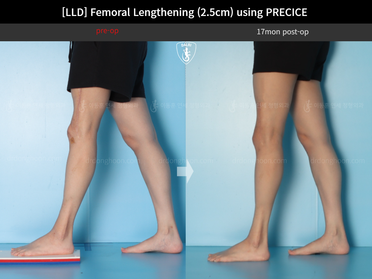 Before and after adult lld, case 18263358, image 7, Dr. Donghoon institute (DALRI)